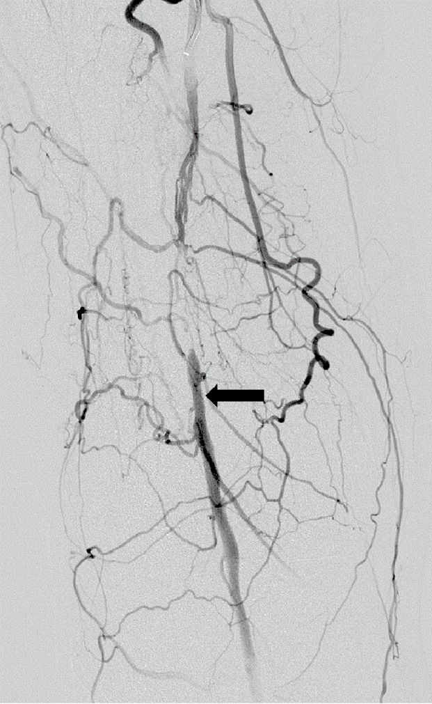 Angiographic image showing the popliteal artery and collateral network around the knee