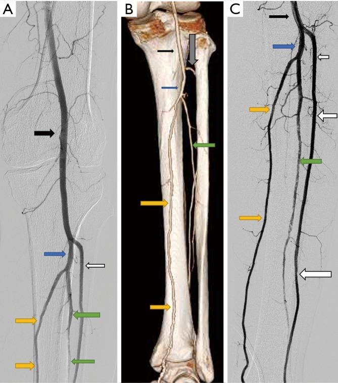 Angiographic image showing the popliteal artery and its trifurcation into anterior tibial, posterior tibial, and peroneal arteries