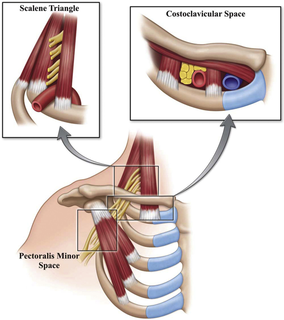 Anatomical illustration showing the three spaces of the thoracic outlet including the interscalene triangle, costoclavicular space, and subpectoral space