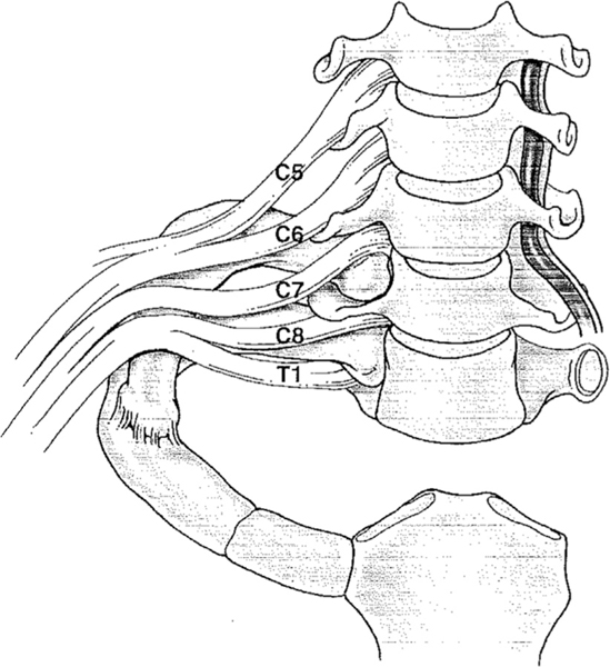 Anatomical illustration showing anomalous cervical rib compressing the subclavian artery and brachial plexus in arterial thoracic outlet syndrome